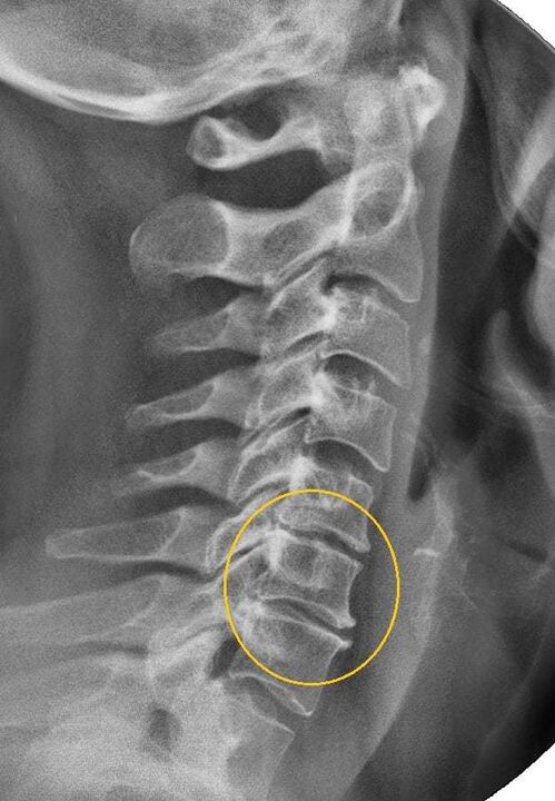 osteochondroza