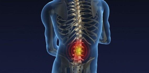 Ból pleców z osteochondrozą lędźwi
