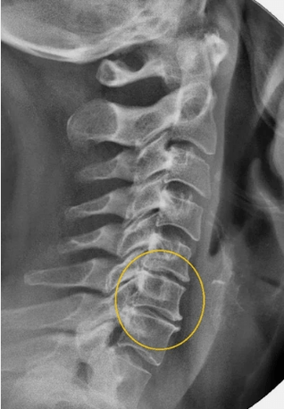 Osteochondroza kręgosłupa szyjnego na x -na
