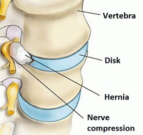 Osteochondroza obszaru szyjki macicy