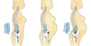 etapy rozwoju osteochondrozy lędźwiowej