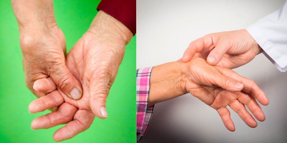 obrzęki i bóle są pierwszymi objawami zapalenia stawów rąk