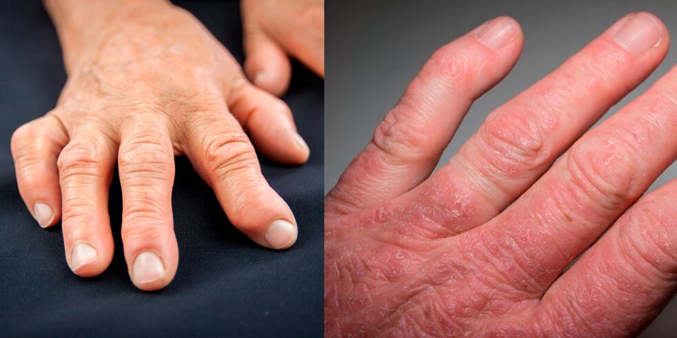 reumatoidalne i łuszczycowe zapalenie stawów rąk