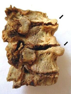 Sekcja kręgosłupa dotknięta osteochondrozą