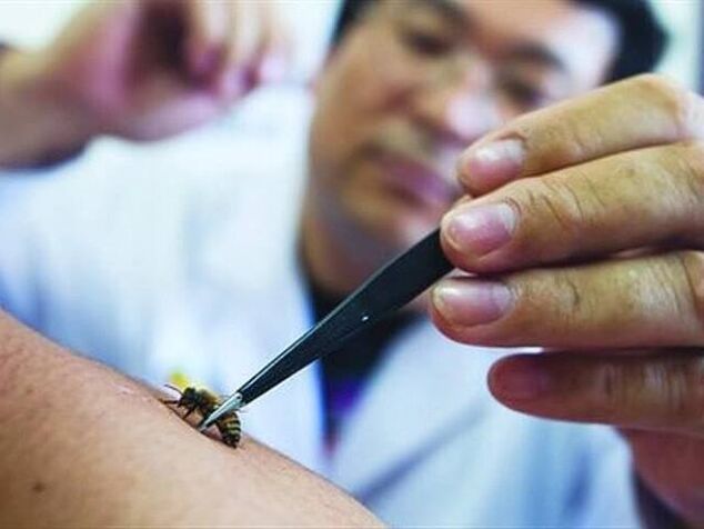 apiterapia osteochondrozy szyjnej