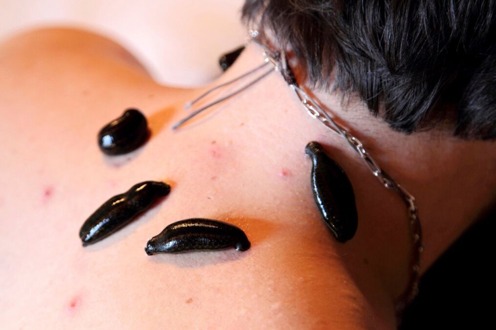 pijawki na osteochondrozę szyjną